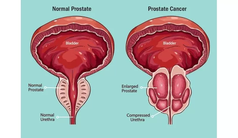Waspada Kanker Prostat Lebih dari Sekadar Masalah Kencing